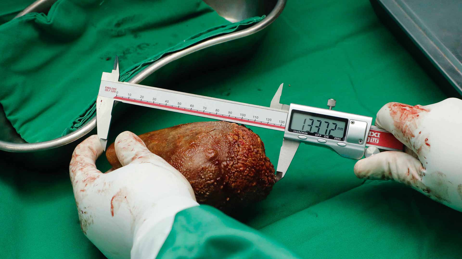 صورة بعنوان: اقتلاع حصوة كلوية بسريلانكا تدخل غينس كأكبر حجم وأثقل وزن بالعالم 