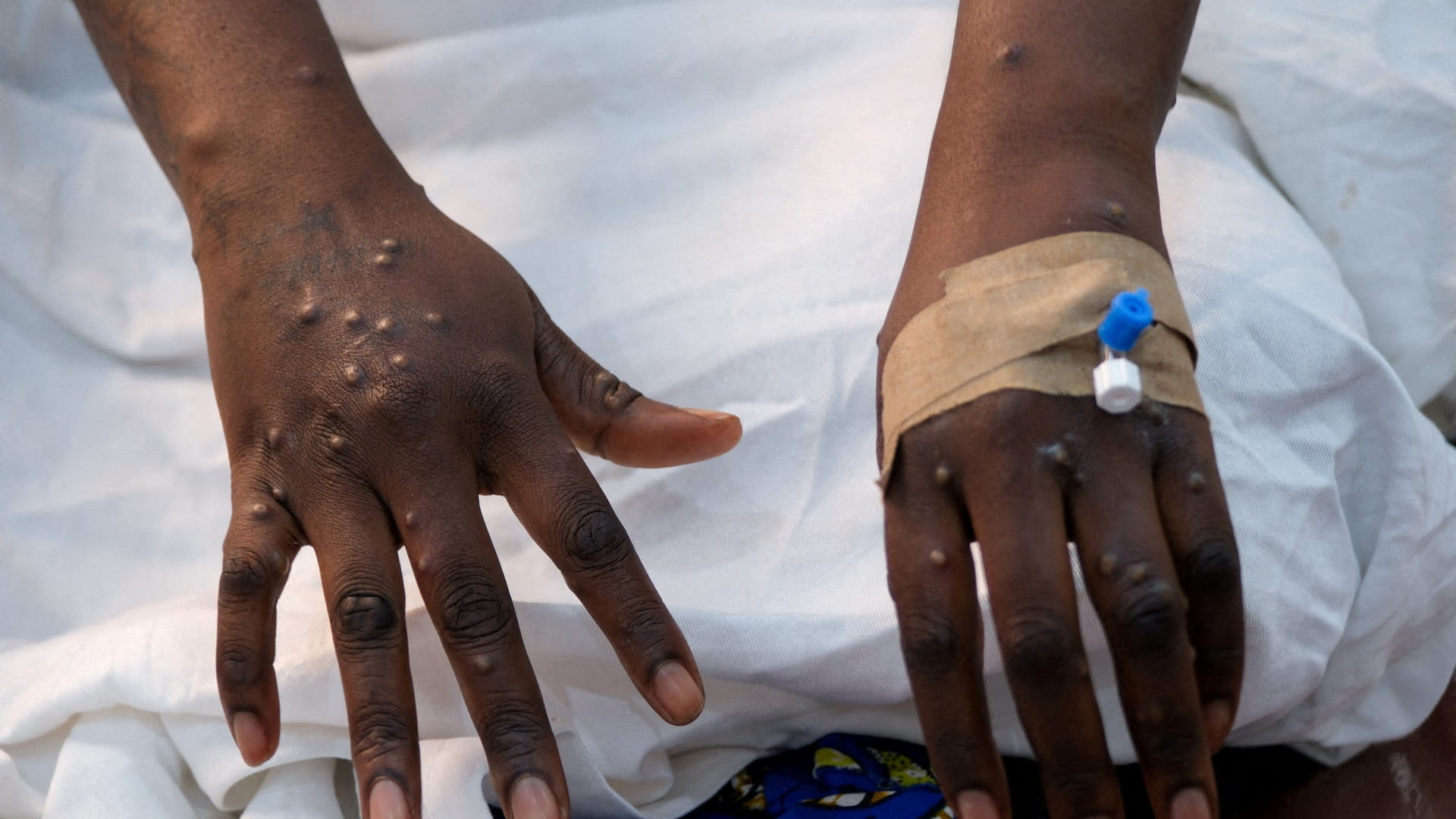 Zambia reports first mpox case, variant unclear 