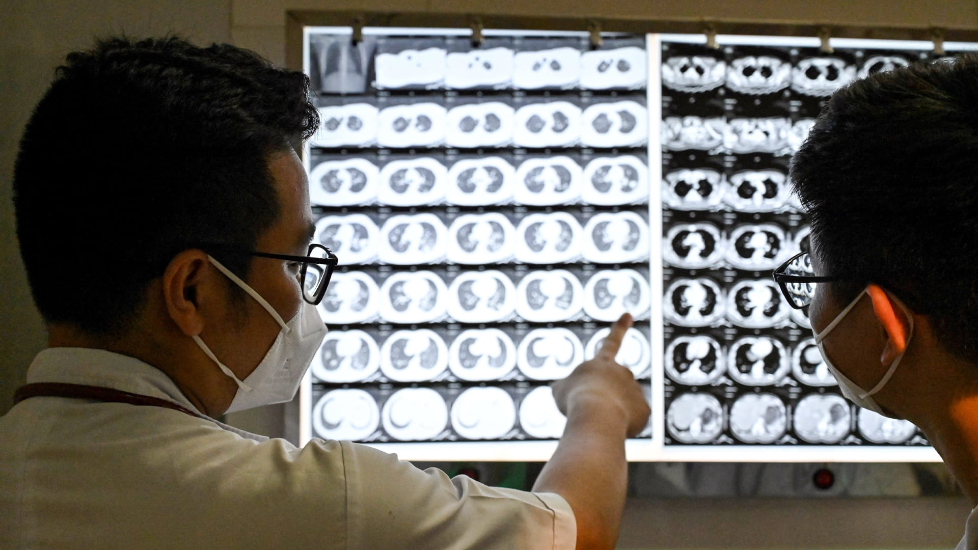  في تقرير صادم.. مرض السل تسبب بوفاة 123 مليون شخص خلال عام 2024 