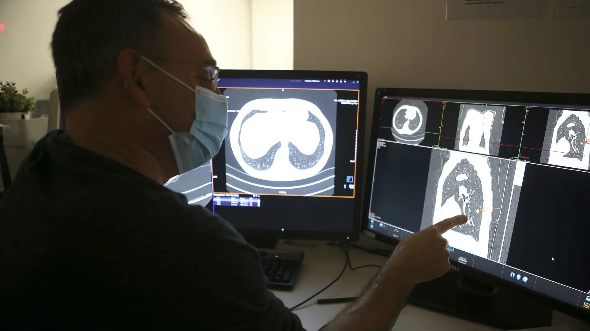 Gene could raise lung cancer risk some 60 times Study